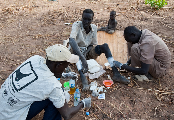 Guinea worm extraction in Southern Sudan.