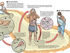 Guinea Worm Facts
