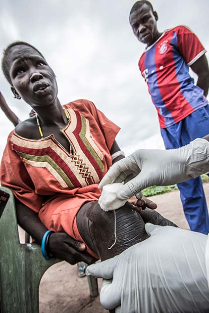 Photo of a Guinea worm being extracted from a South Sudanese woman's knee.