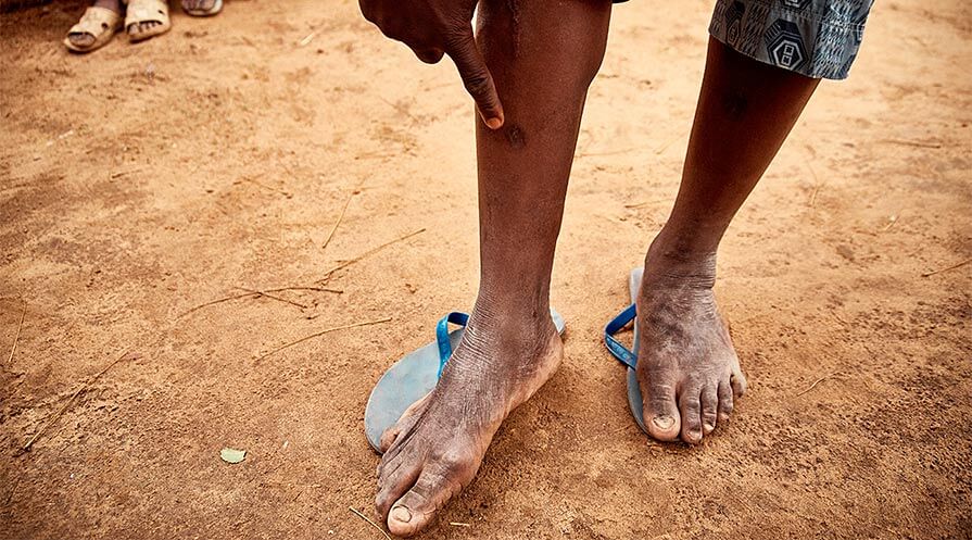 Moustapha points to one of his Guinea worm scars.