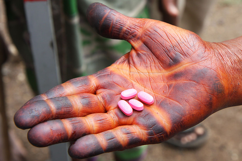  A local resident in Ethiopia holds an adult dose of the drug Zithromax ® 